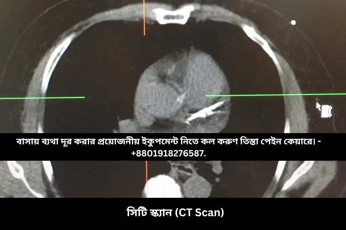 সিটি স্ক্যান (CT Scan)