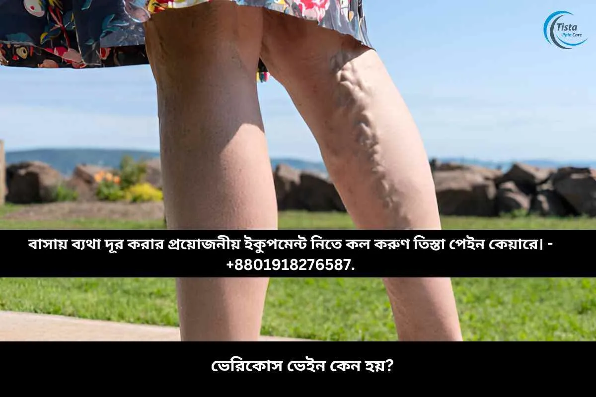 ভেরিকোস ভেইন কেন হয়?